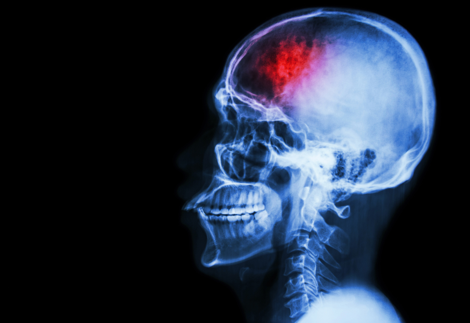 Training AI to diagnose strokes more quickly and accurately