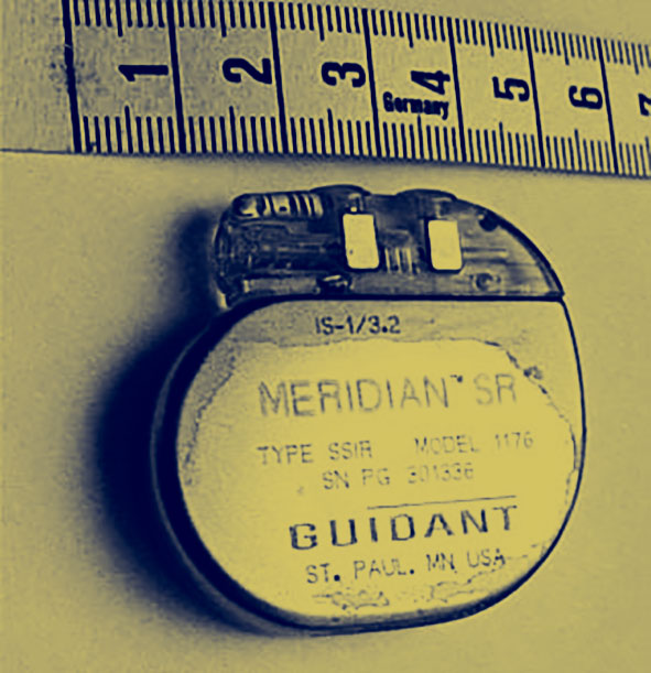 An early version of a pacemaker