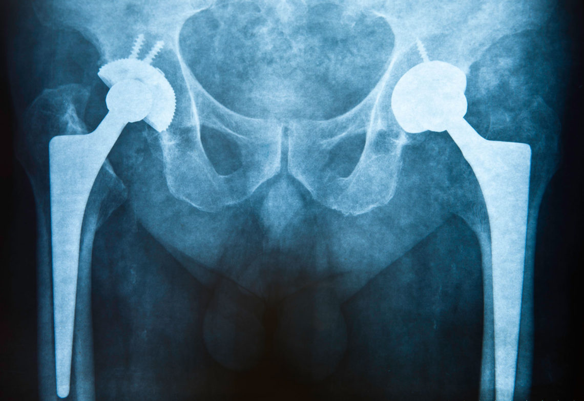 new coating for implants to reduce rejection and infection