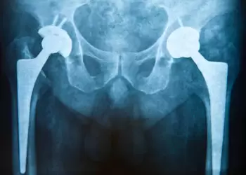 new coating for implants to reduce rejection and infection